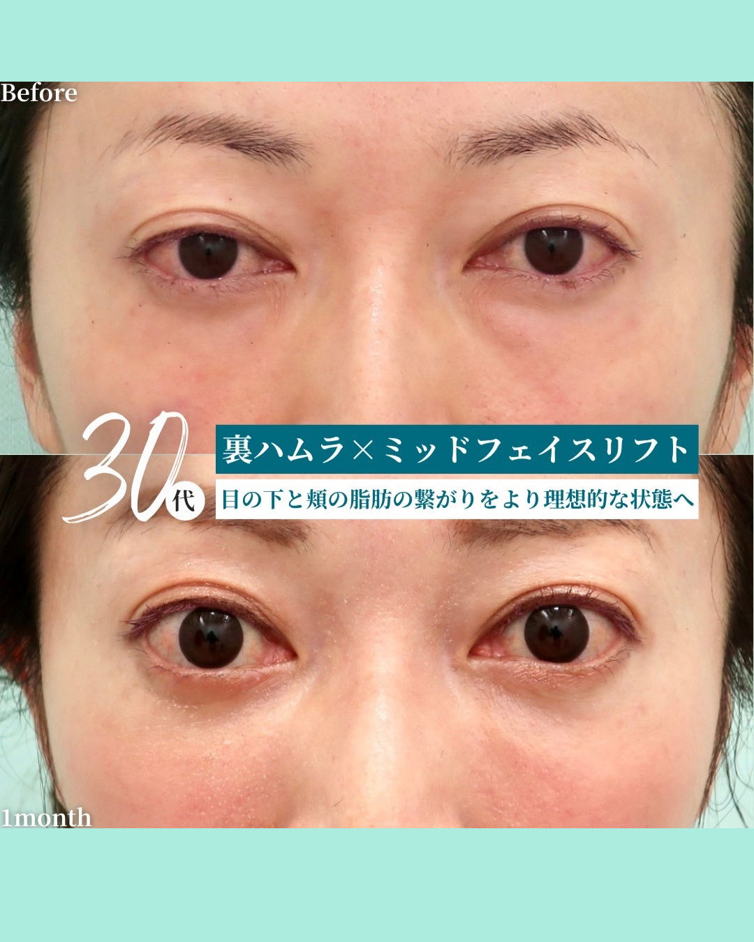 裏ハムラ　ミッドフェイスリフト