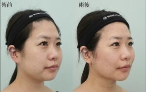 『脂肪吸引で一気に垢抜け！ポイントはマイナー部位への複合アプローチ。』の画像