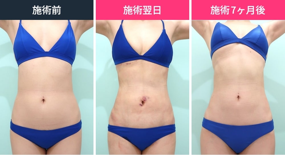 お腹・腰の脂肪吸引のビフォーアフター