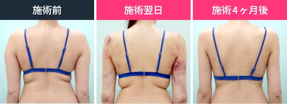 二の腕・肩・付け根の脂肪吸引のビフォーアフター