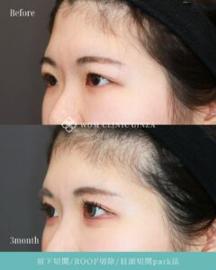 眉下切開+ROOF切除+目頭切開(park法)の症例写真