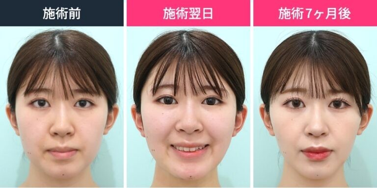 顎下の脂肪吸引のビフォーアフター