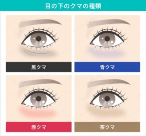 目の下のクマの種類