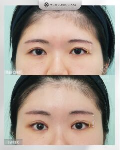 額挙上（前額リフト）の症例01