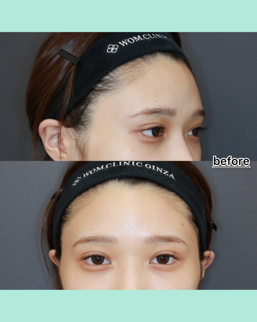 『奥目を解消！内視鏡前額リフト×眉骨削りで叶える明るい目元』の画像