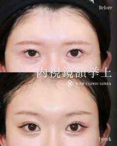 前額リフト(内視鏡額挙上)の症例写真