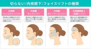 内視鏡フェイスリフト