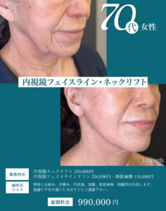 フェイスリフトの症例1