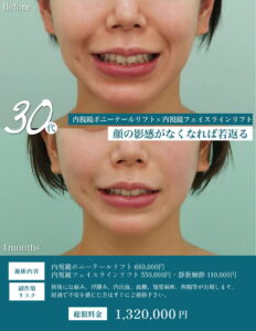 フェイスリフトの症例2
