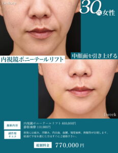 フェイスリフトの症例3