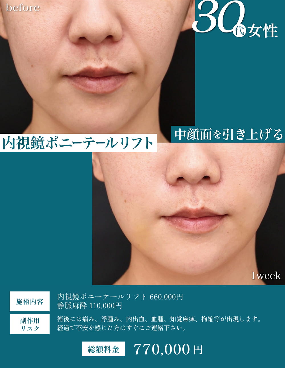フェイスリフトの症例3