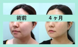 頬・顎下脂肪吸引+バッカルファット除去の症例写真