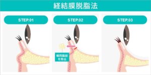 目の下脂肪取り