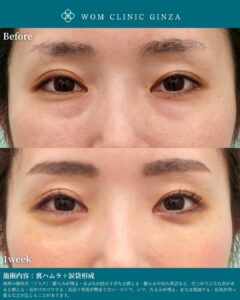 裏ハムラ＋涙袋形成（裏ハムラ併用）の症例写真