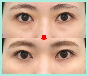 目の下脂肪取り（経結膜下瞼脱脂術）＋目の下の脂肪注入の症例写真
