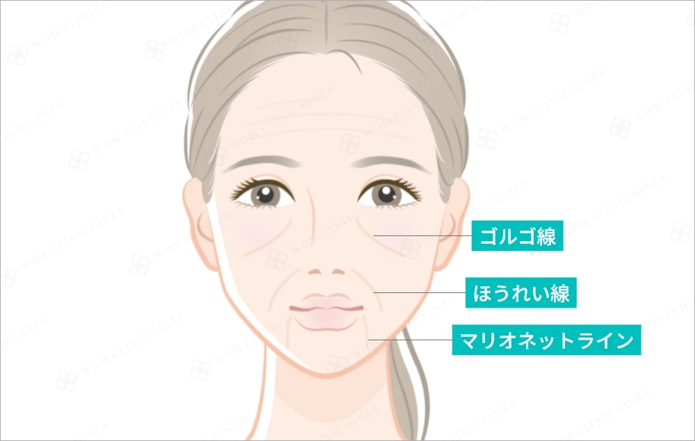 ゴルゴ線・マリオネットライン・ほうれい線の違い