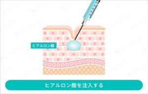 ヒアルロン酸注入