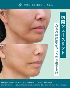切開フェイスリフト+脂肪注入の症例写真