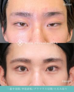 二重全切開+挙筋前転(眼瞼下垂手術)+グラマラス切開+上まぶたたるみ取りの症例写真