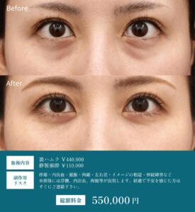 裏ハムラの症例写真01