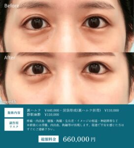 裏ハムラの症例写真02