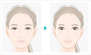 内視鏡ポニーテールリフト