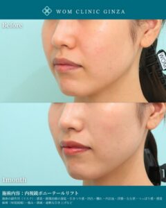 内視鏡ポニーテールリフトの症例写真