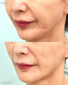 内視鏡ポニーテールリフト+内視鏡フェイスラインリフトの症例写真