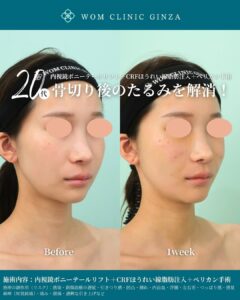 内視鏡ポニーテールリフト+脂肪注入+ペリカン手術の症例写真