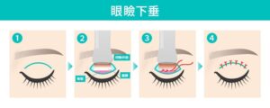 眼瞼下垂手術