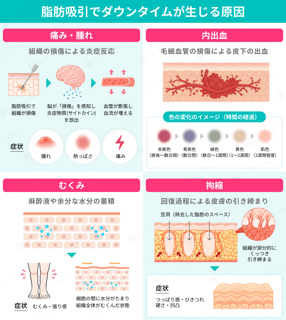 脂肪吸引でダウンタイムが生じる原因を説明する図