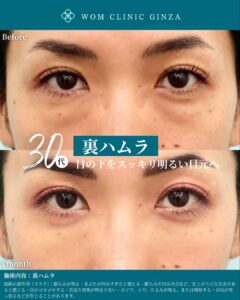 裏ハムラの症例写真