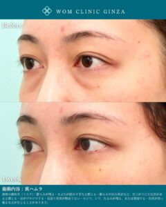 裏ハムラの症例写真