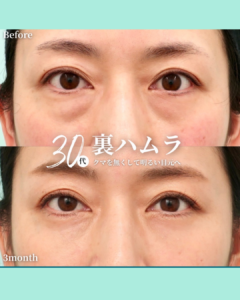 裏ハムラ法の症例写真