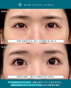 裏ハムラ+涙袋形成の症例写真01