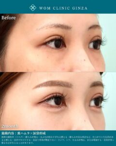 裏ハムラ+涙袋形成の症例写真02