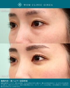 裏ハムラ+涙袋形成の症例写真