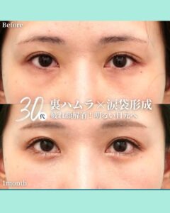 裏ハムラ法＋涙袋形成の症例写真