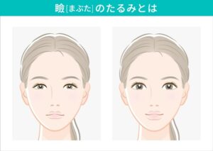 まぶたのたるみとは