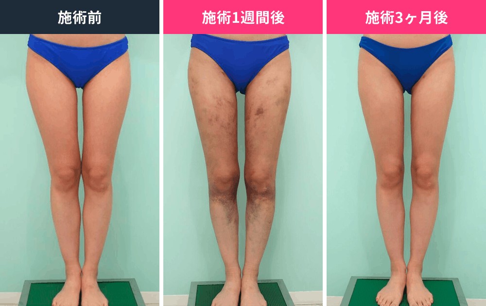 太もも・膝まわりの脂肪吸引のビフォーアフター