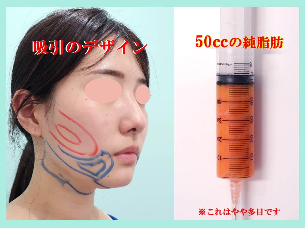小顔吸引手術デザイン写真