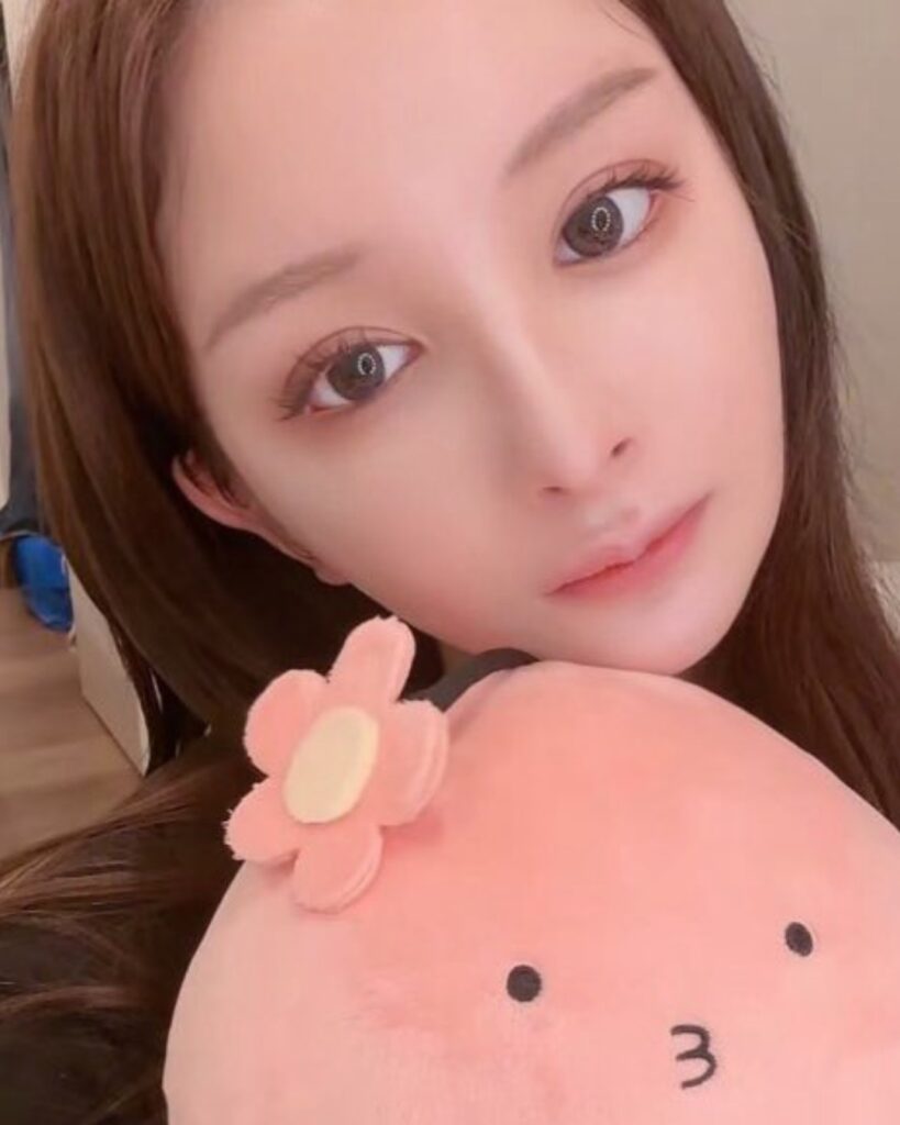 可愛い子はやっている内視鏡額挙上 AFTER写真