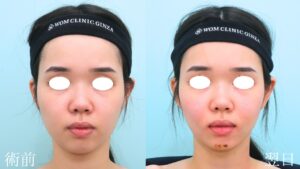 『『BMI16』痩せているのに脂肪吸引?』の画像