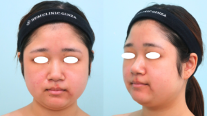 『『小顔/輪郭形成』上・下顔面へのトータルアプローチで理想の輪郭に。』の画像