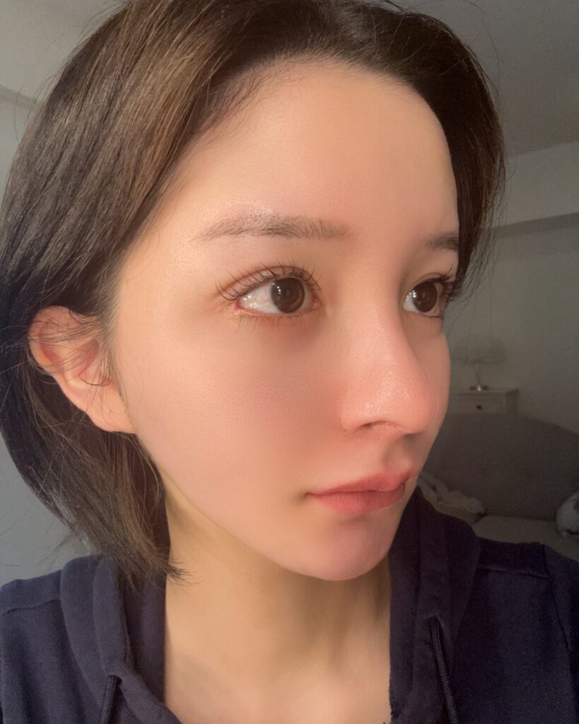 可愛い子はやっている内視鏡額挙上 BEFORE写真