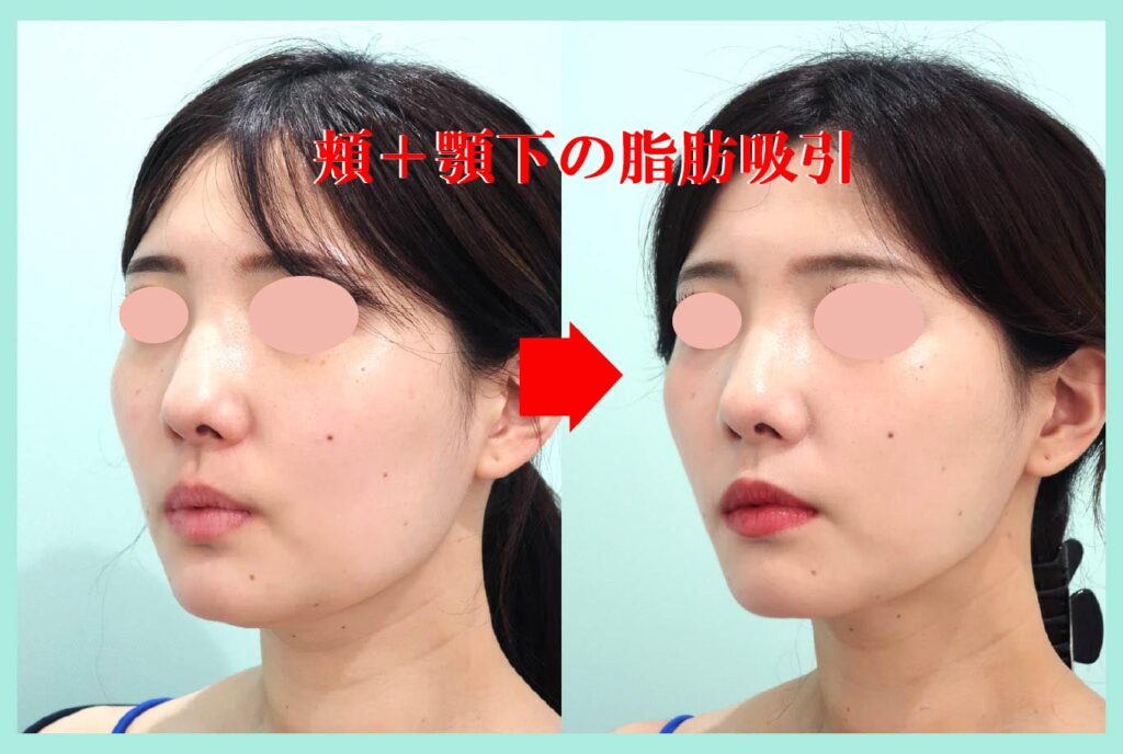 小顔吸引手術後斜め写真