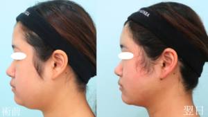 『『小顔/輪郭形成』上・下顔面へのトータルアプローチで理想の輪郭に。』の画像