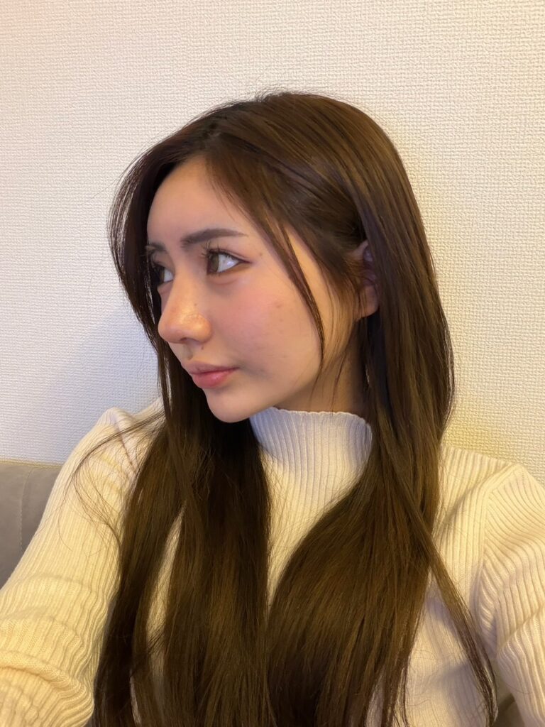 わし鼻を解消 AFTER写真