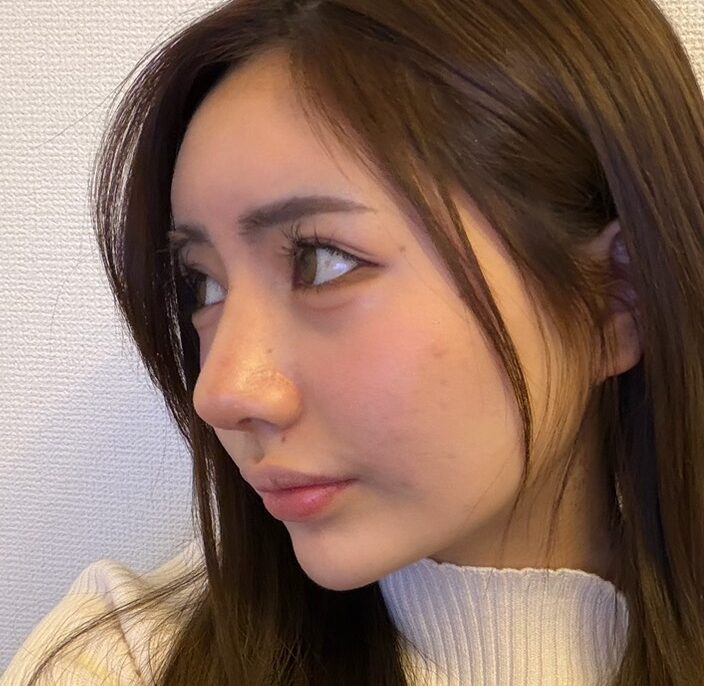 わし鼻を解消 AFTER写真