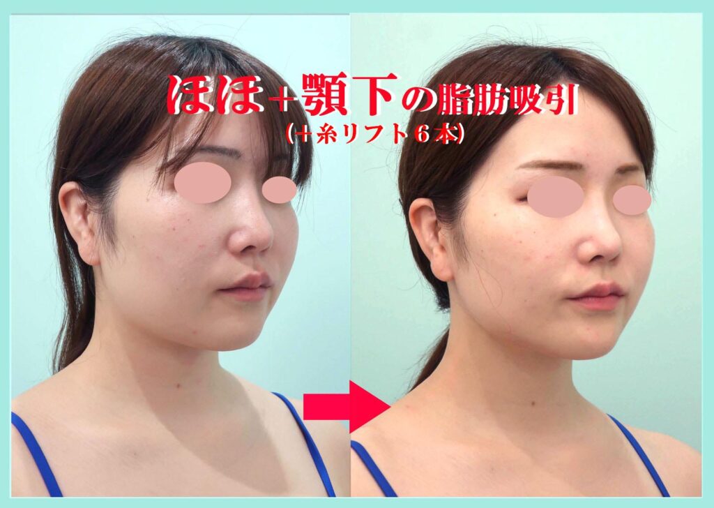 『こんなに綺麗なフェイスラインになる、私の「頬+顎下」のベイザー脂肪吸引』の画像